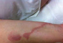 Dermatologista alerta sobre período de aumento de potós que causam queimaduras de até 2º grau